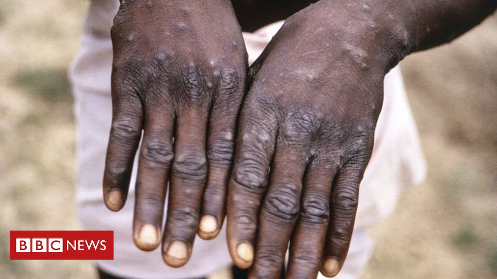 Monkeypox: More than 200 contacts tracked in US for rare disease